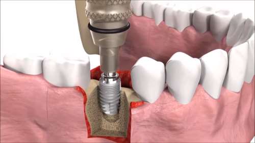 Установка зубного имплантата