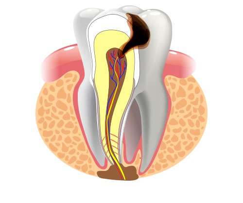 зуб с периодонтитом