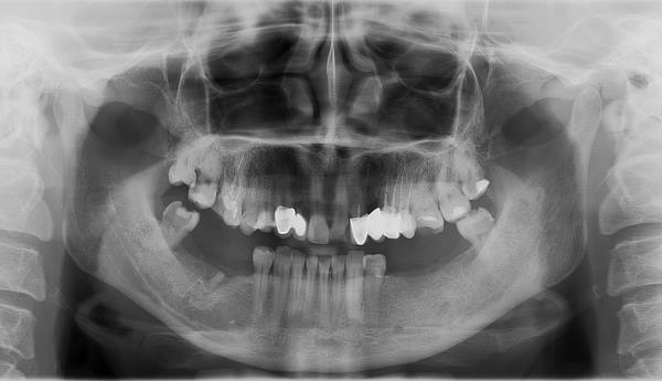 рентгенодиагностика зубов - снимок