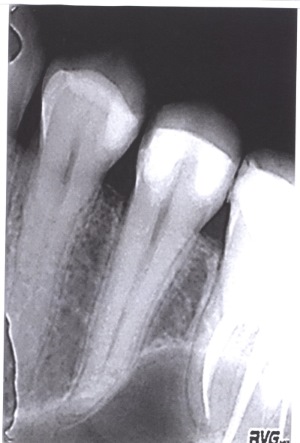 снимок зуба